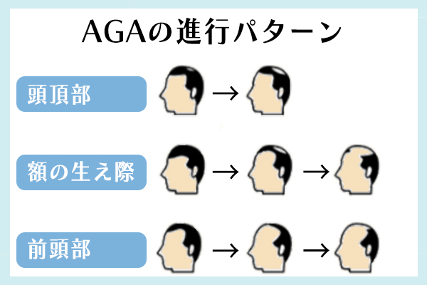 AGAの進行は、頭頂部や額の生え際、前頭部やつむじ周囲の３パターン