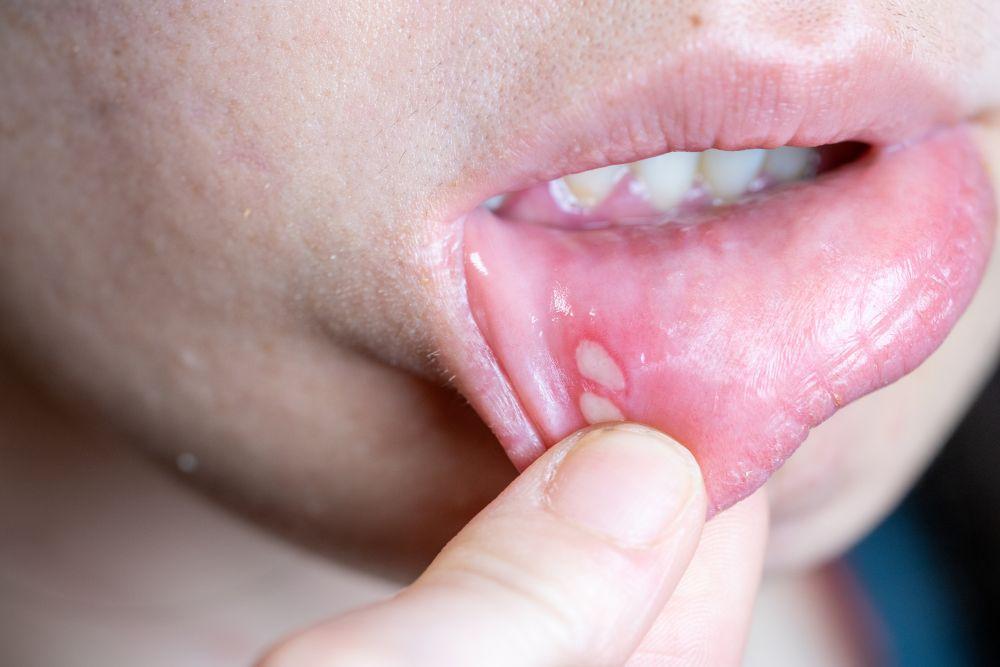 口内炎には赤いものと白いものがある！違いや種類、できる原因、治し方まで詳しく解説