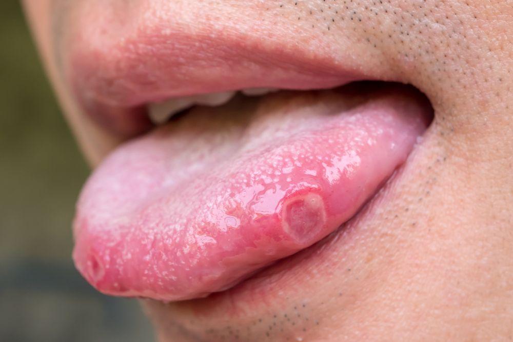 舌にできた赤い口内炎