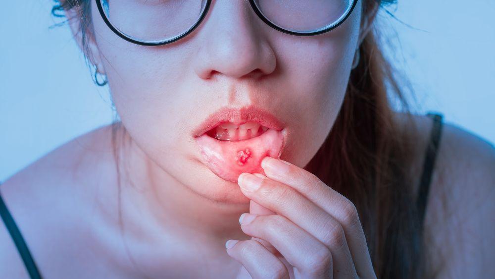 生理前に口内炎が増える？関係性や痛い口内炎の対処法をわかりやすく解説