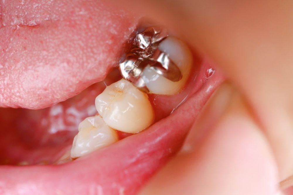 治療後の銀歯