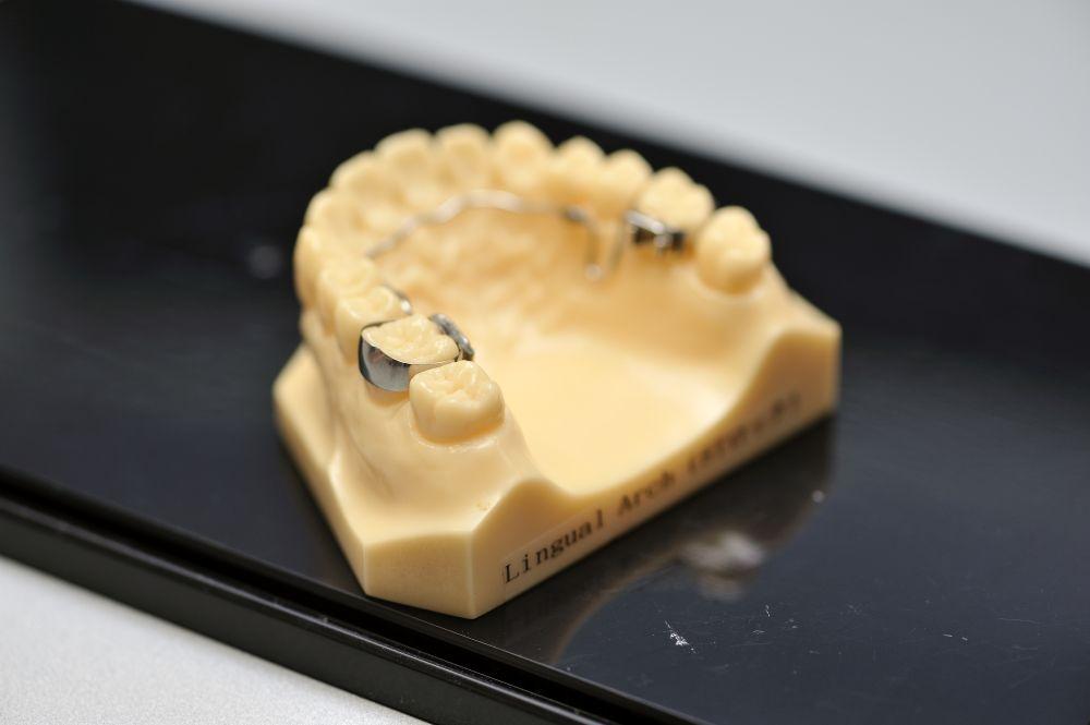 銀歯が入った歯の模型